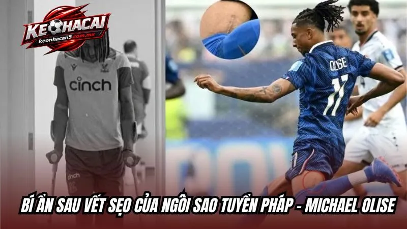 Bí ẩn sau vết sẹo của ngôi sao tuyển Pháp - Michael Olise